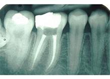 endodoncja sanok - dentysta z sanoka
