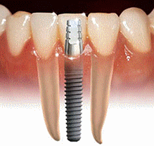 chirurgia szczękowa i implanty - dobry dentysta sanok