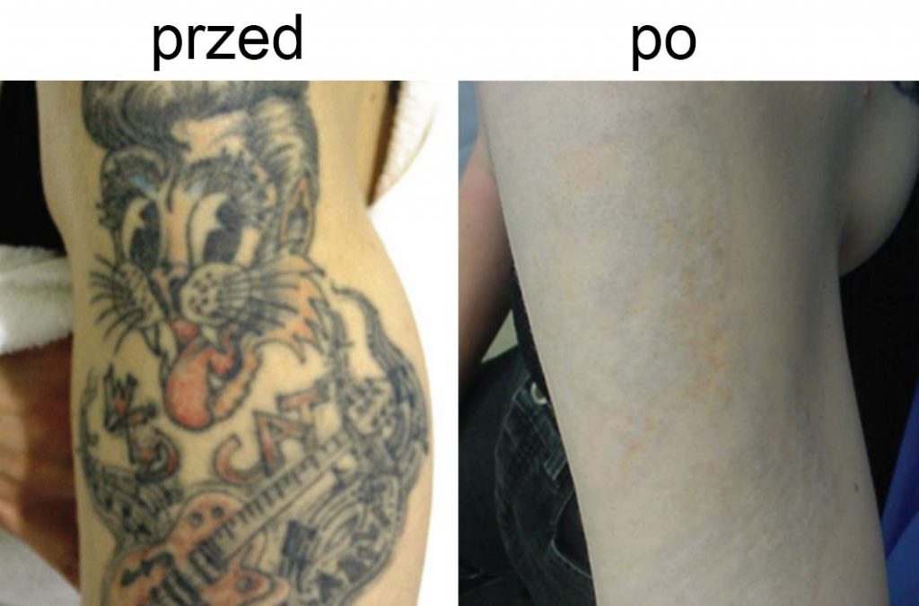 efekty usuwania tatuażu przed/po