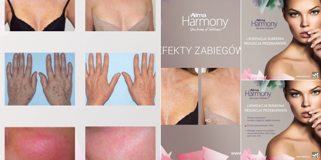 Efekty przed i po zabiegu usuwającego przebarwienia